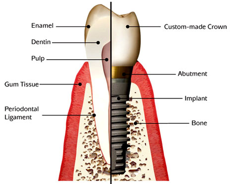 model showing the parts of a dental implant