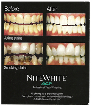 teeth_whitening